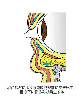 クマ（目袋）が目立つようになってきた下眼瞼の断面