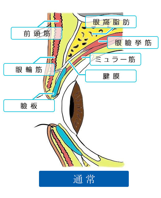 眼瞼下垂症