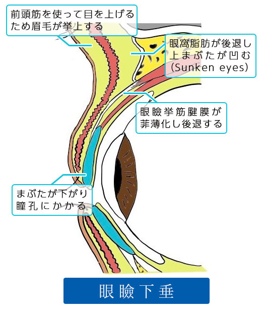 眼瞼下垂症