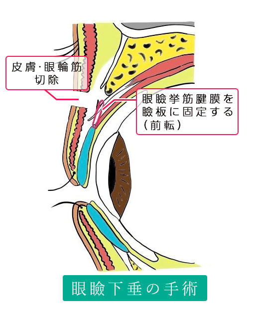 眼瞼下垂症